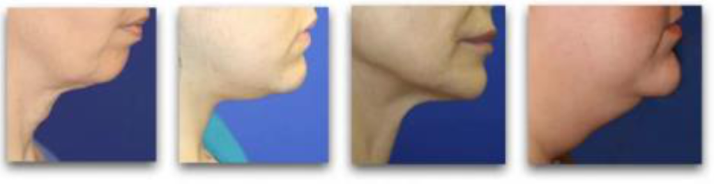 Woman receiving InstaSculpting body sculpting treatment with ultrasonic cavitation and RF skin tightening for fat reduction, smoother skin, for smooth and tight chin.