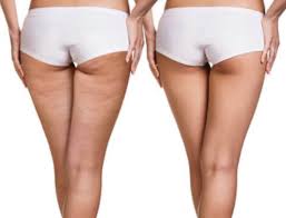 A woman shows her toned looking thighs after receiving lypossage